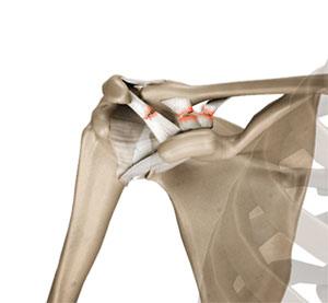 AC Joint Separation