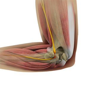 Ulnar Nerve Release Centreville, VA  Ulnar Nerve Decompression Reston, VA