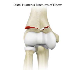 ORIF of the Humerus Fractures