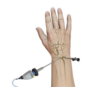 Distal Radioulnar Joint (DRUJ) Arthritis