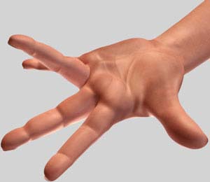 Dupuytren’s Contracture?