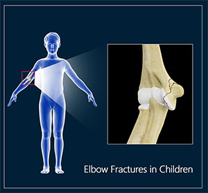 Elbow Fractures in Children