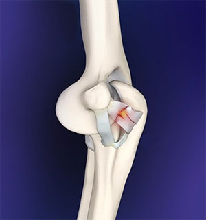 Elbow Ligament Reconstruction