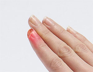 Fingertip Injury