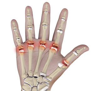 Metacarpophalangeal (MCP) Joint Arthritis