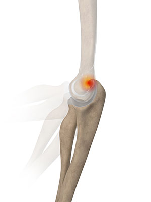 Posterior Impingement of the Elbow