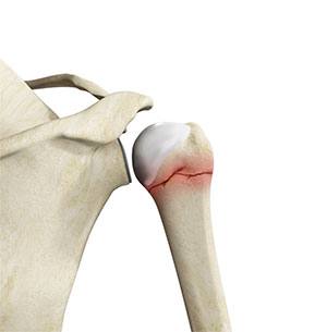 Proximal Humerus Fractures