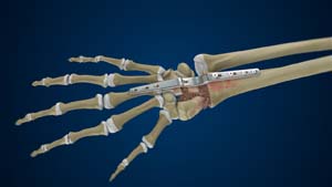 total Wrist Arthrodesis