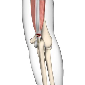 Triceps Injuries