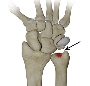 Ulnar Carpal Impaction