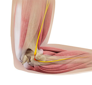 Ulnar nerve entrapment