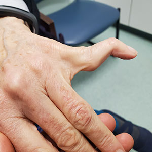 Boutonniere Deformity