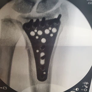 Distal Radius Fractures