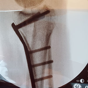 Distal Radius Fractures