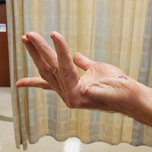 Dupuytren's Contracture